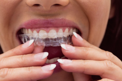 allineare denti andria lepidi suriano